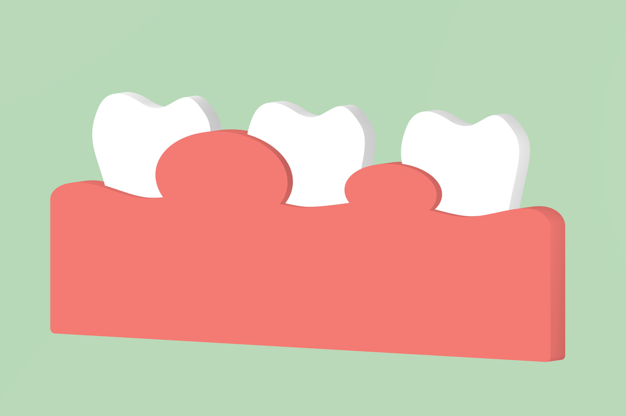 graphic of teeth with enlarged gums between