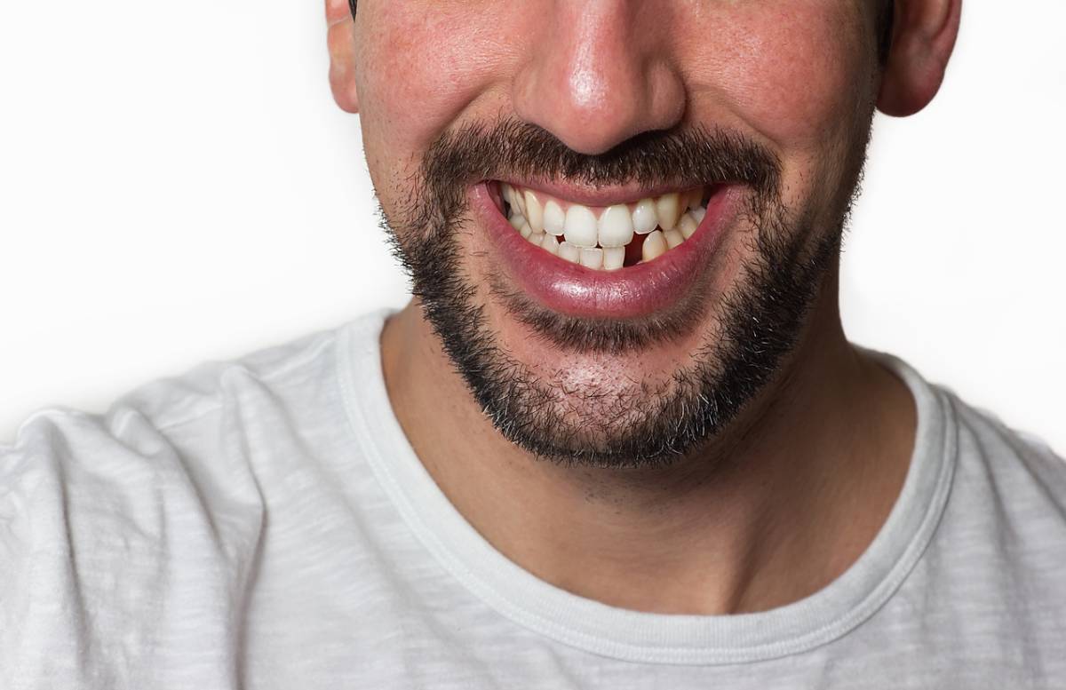 man smiling with missing tooth