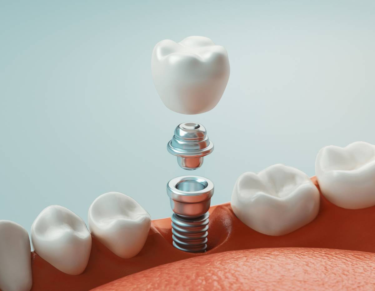 graphic of dental implant components being placed among row of teeth