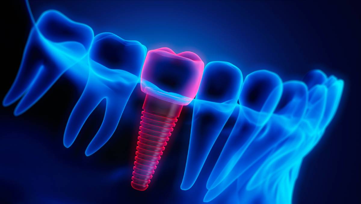 3d concept image of dental implants