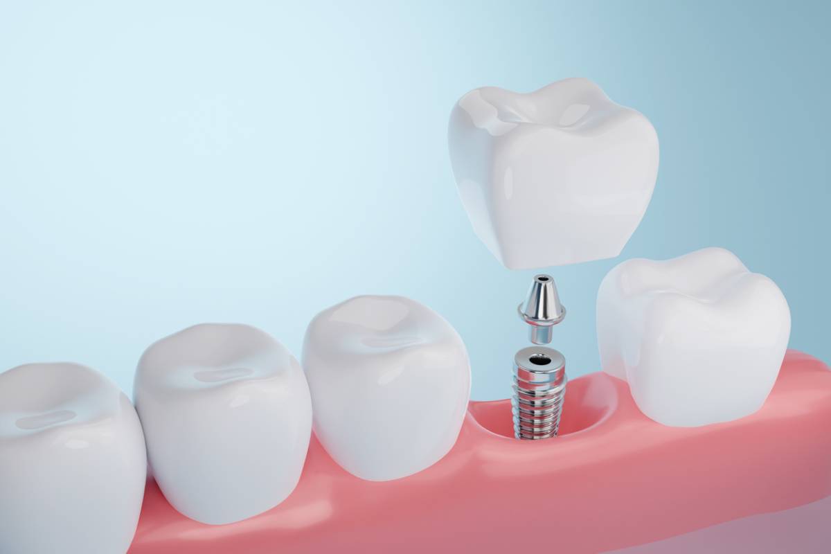 featured image for temporary implants article