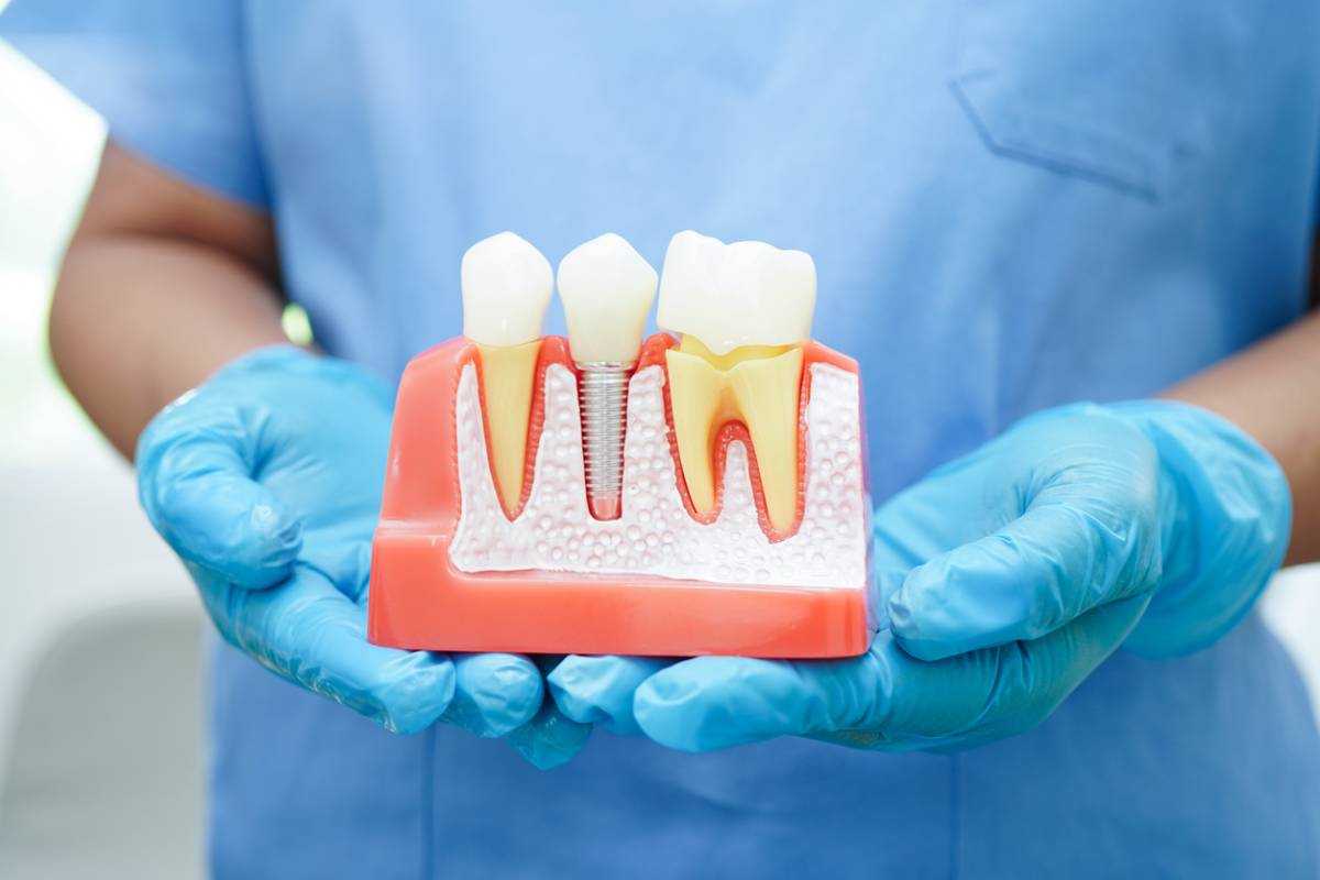 featured image for guide to the first days after dental implants