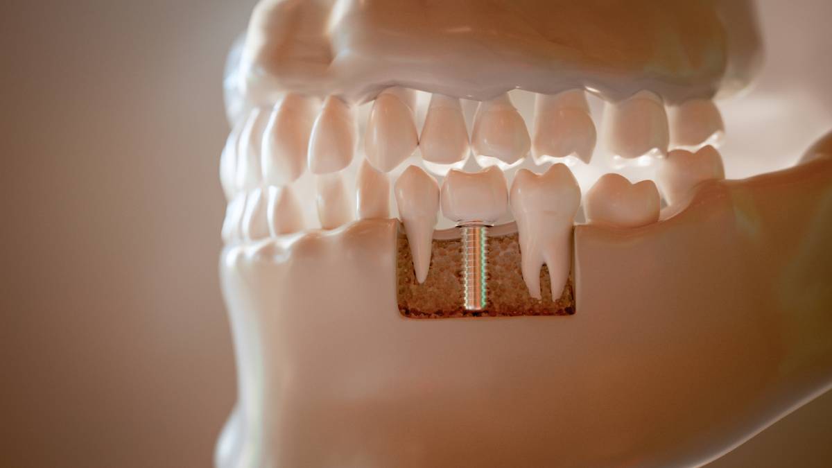 Feature image for Do Dental Implants Hurt?