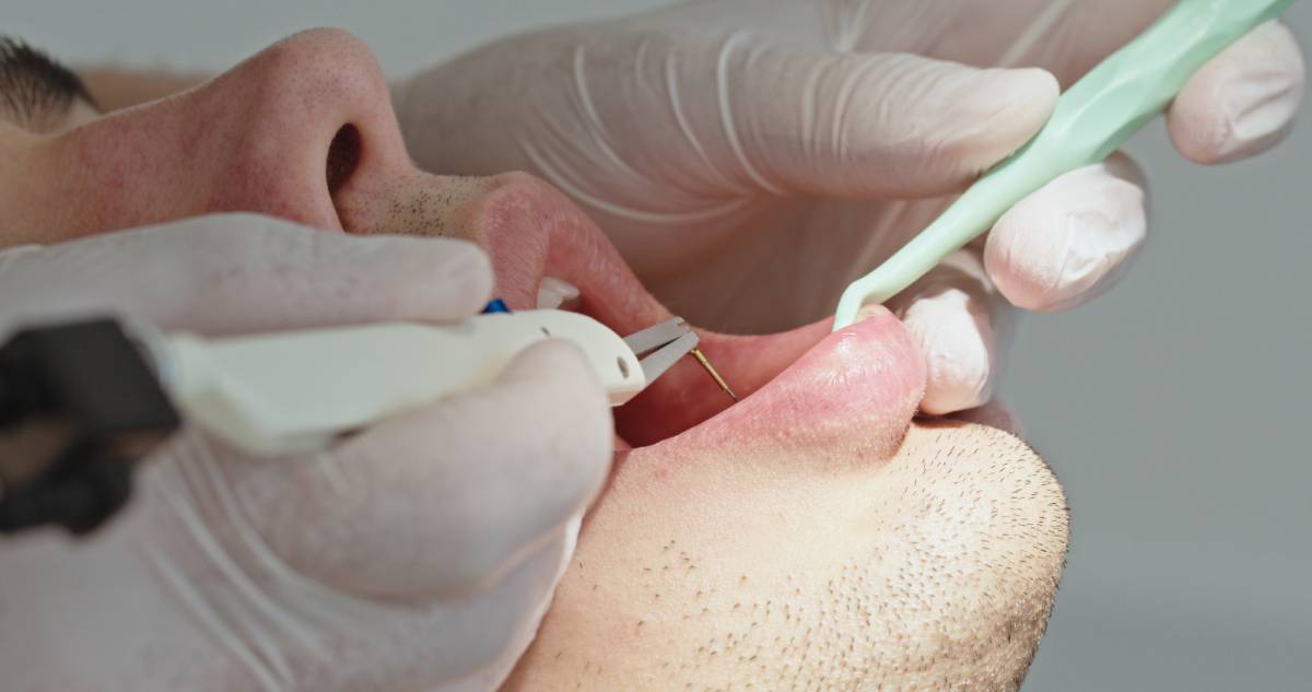 Close-Up of Dentist Checking Gums with Periodontal Probe